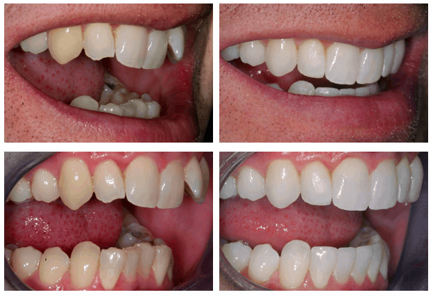 aligners before and after