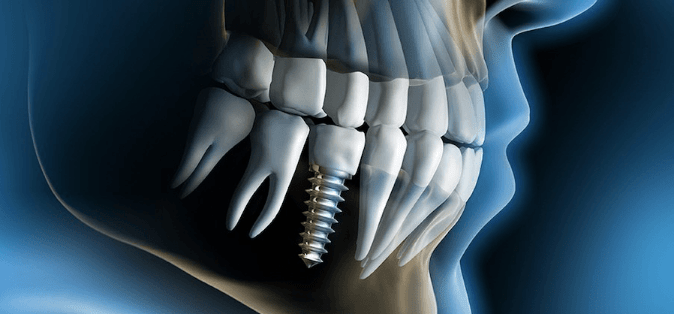 dental implants liverpool