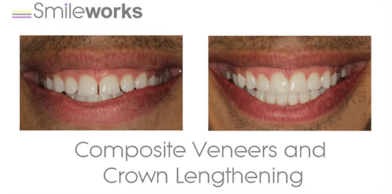 composites and crown lengthening before and after