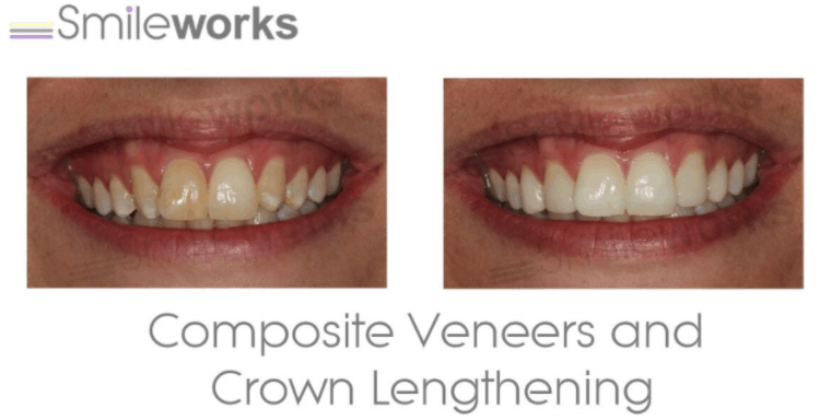 Composite resin bonding before and after