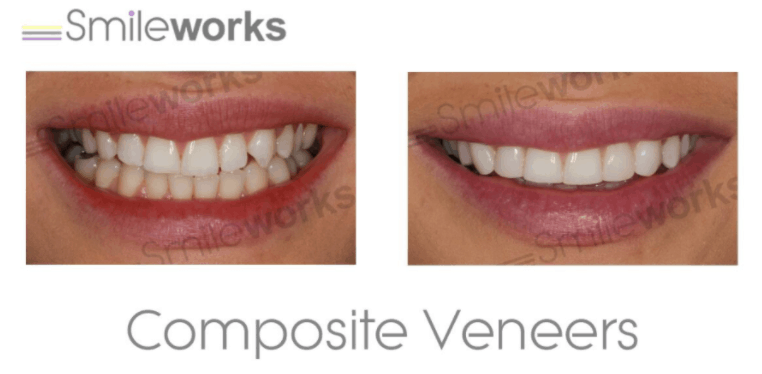 Composite bonding before and after