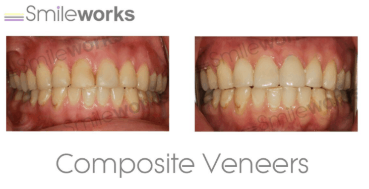 Compare composite bonding cases