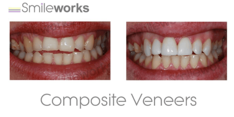 Composite bonding best case