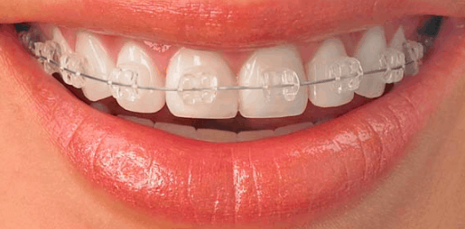 Invisalign Liverpool Invisible Clear Braces Cost 73 51p M