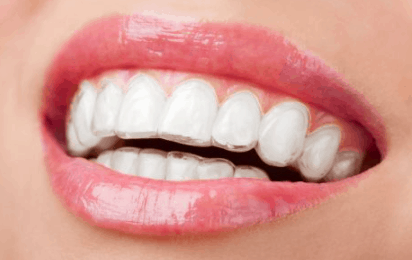 invisalign invisible retainers