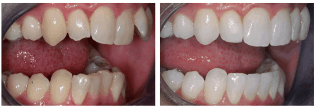 Inman Aligner Liverpool The Remarkable 16 Week Removable Braces
