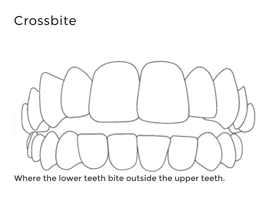 Crossbite correction