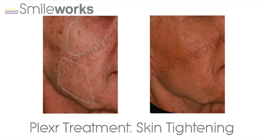 Skin tightening with Plexr