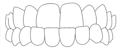 underbite clear braces