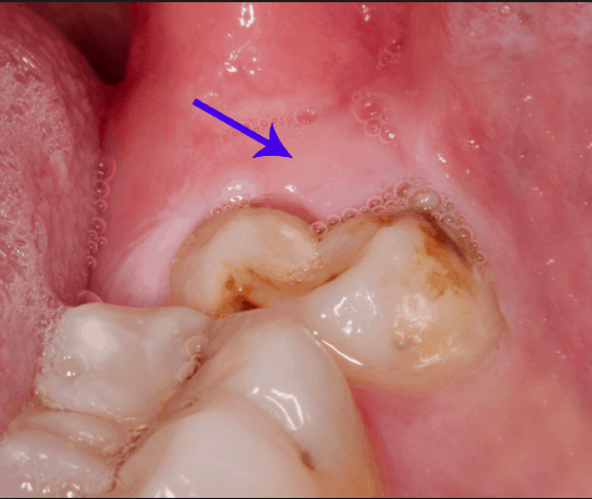 Wisdom tooth eruption