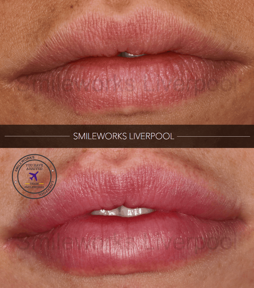 Lip Fillers Liverpool Full, Plump and Natural Lips from just £170