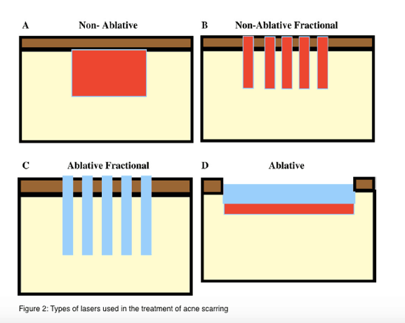 types of lasers used in treatment of acne scarring