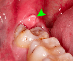 what does a wisdom tooth coming through look like?