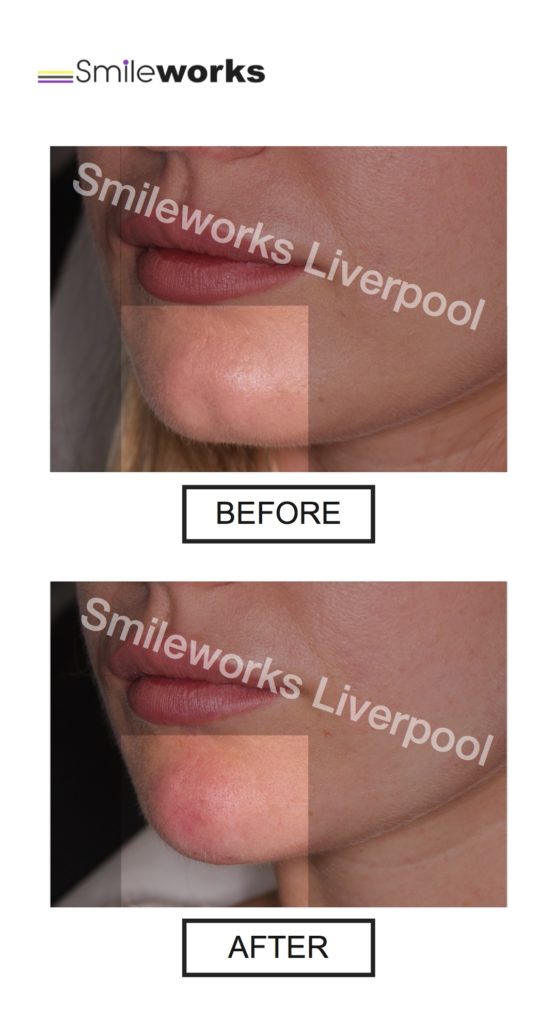 Chin Fillers Liverpool