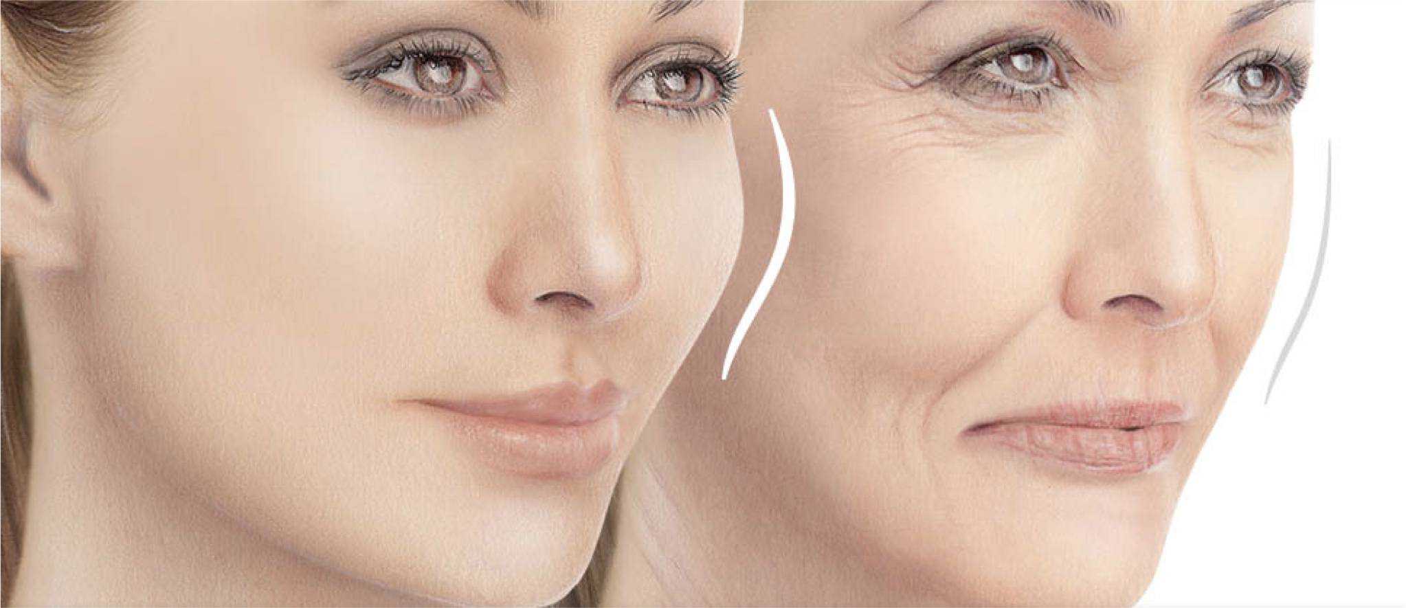 dermal fillers