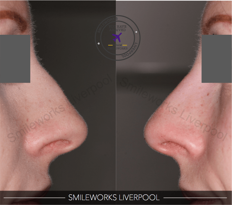 nose filler gallery before and after