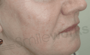 Non surgical face lift before