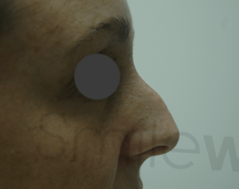 Non surgical nose reshaping before