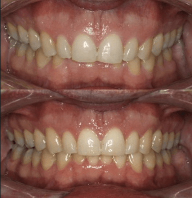 Overbite before and after