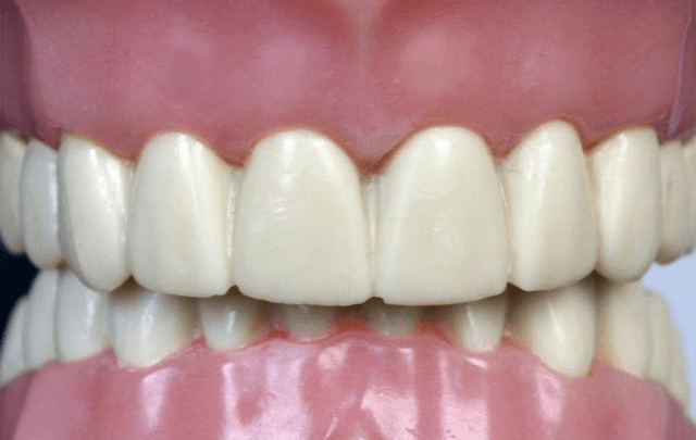 What is an Overbite?  Deep Overbite Treatment for Adults