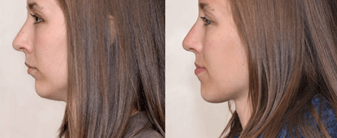 overbite treatment Liverpool