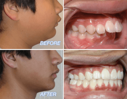 Overbite  Tunbridge Wells Orthodontics