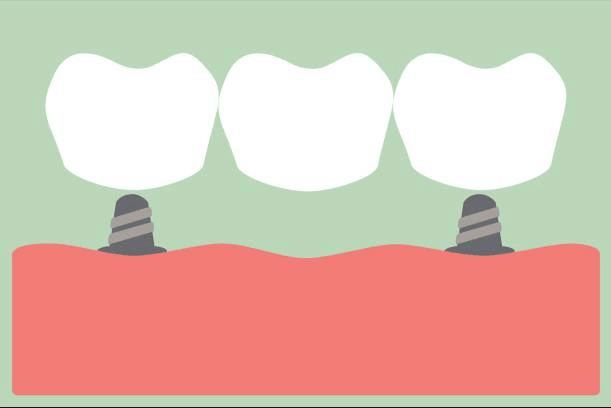 Dental Bridge