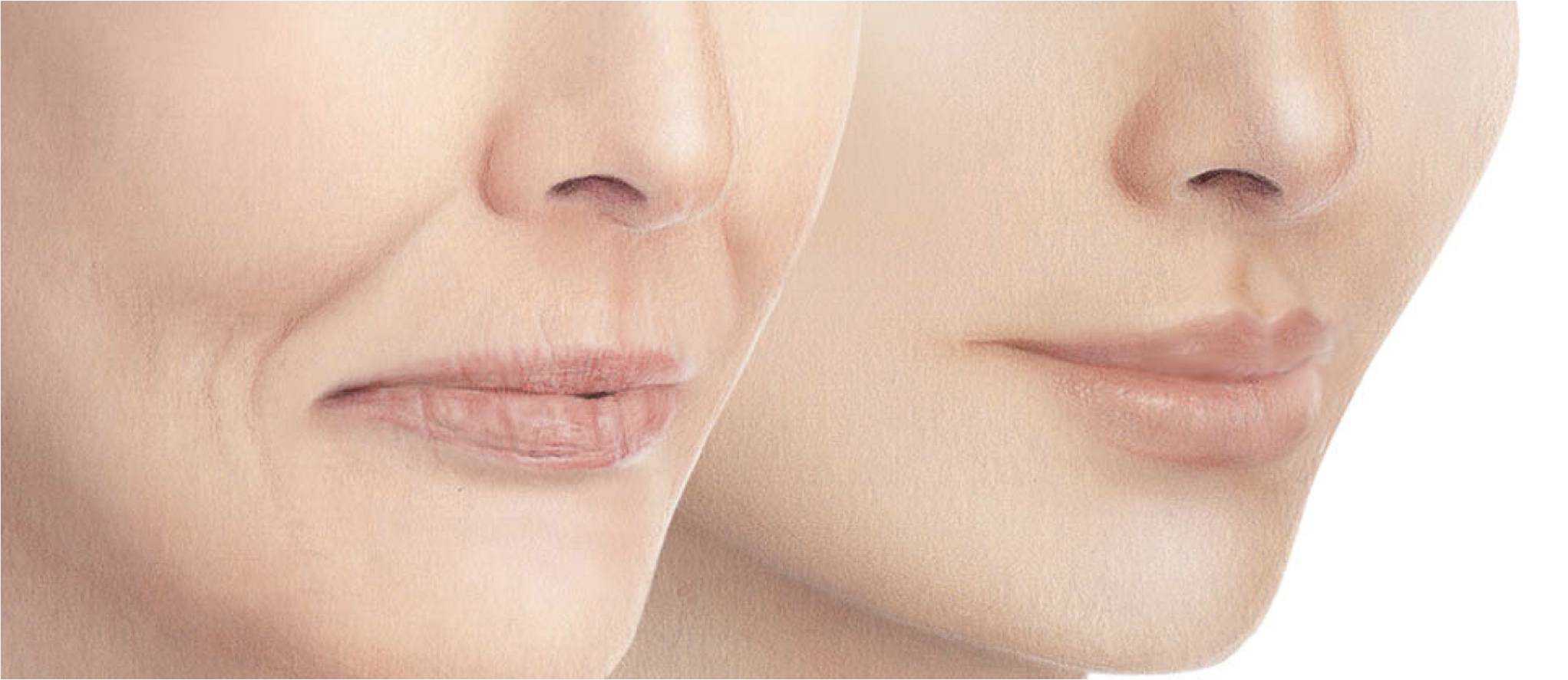 dermal fillers liverpool