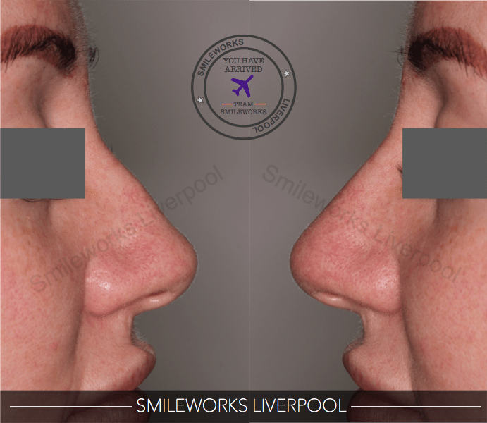 Nose reshaping 2 before and after shot