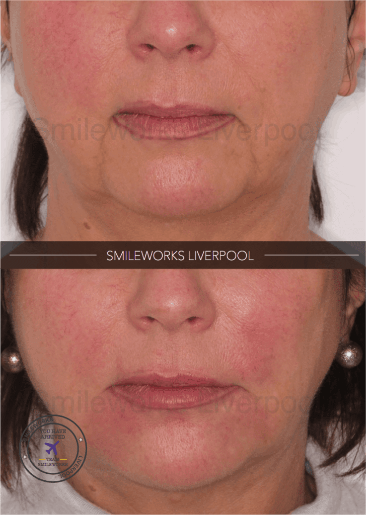 Lower facial volume with Voluma