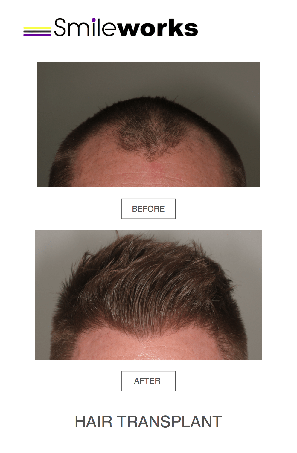 Hair transplant male norwood scale 3 before and after