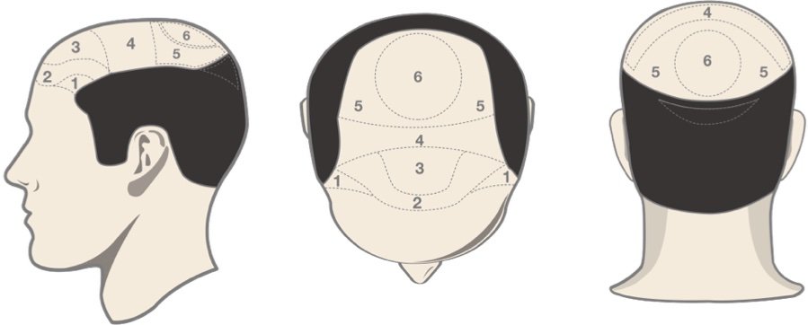 hair transplant cost calculator