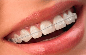 ceramic clear braces