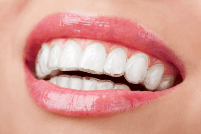 Invisalign Cost