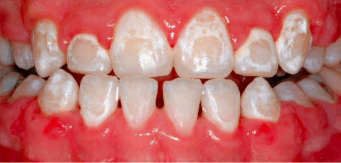 Image result for White Spots on Teeth