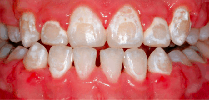 white spots on teeth