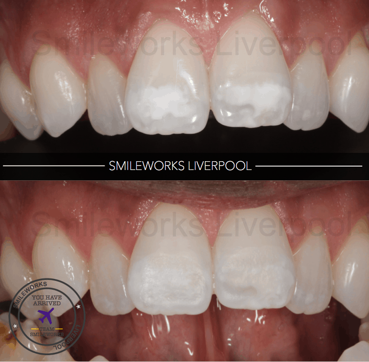 ICON: Treat Tooth Decay & Remove White Spots Without Drilling