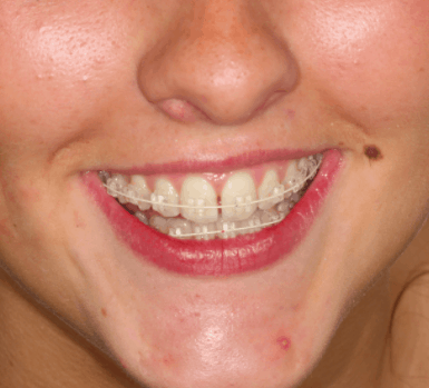 Six Month Smile braces