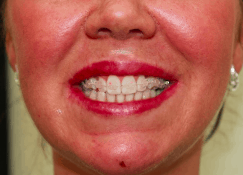 6 Month Smile brackets