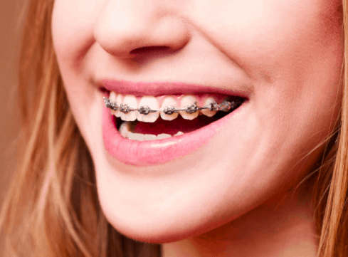 traditional metal braces