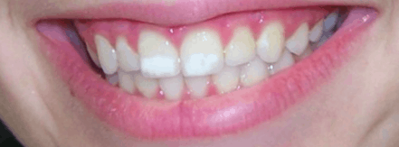 White Marks on Teeth | How to Remove Them | Price, Review & pictures