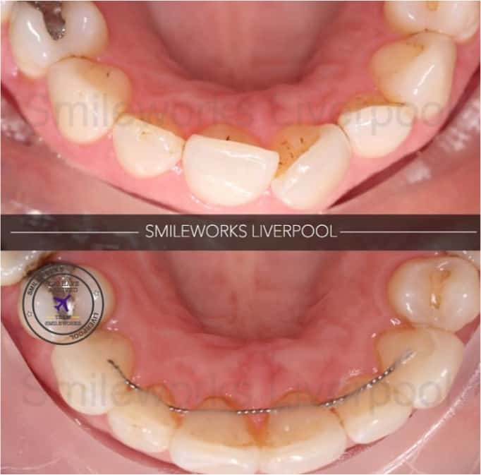 SIx month smiles moving the front six teeth into position