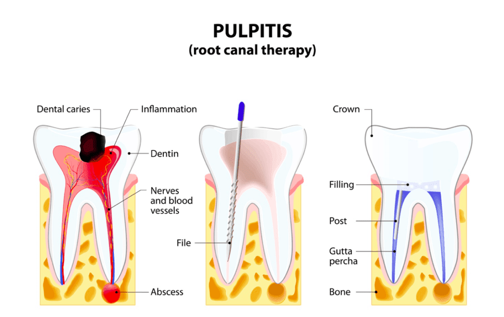 Pulpitis and root canal therapy