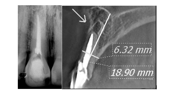 Radiograph of an upper incisor