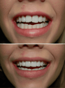 composite bonding vs snap on smile