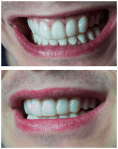 clip on veneers liverpool