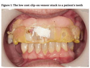 Clip on veneers damaged teeth