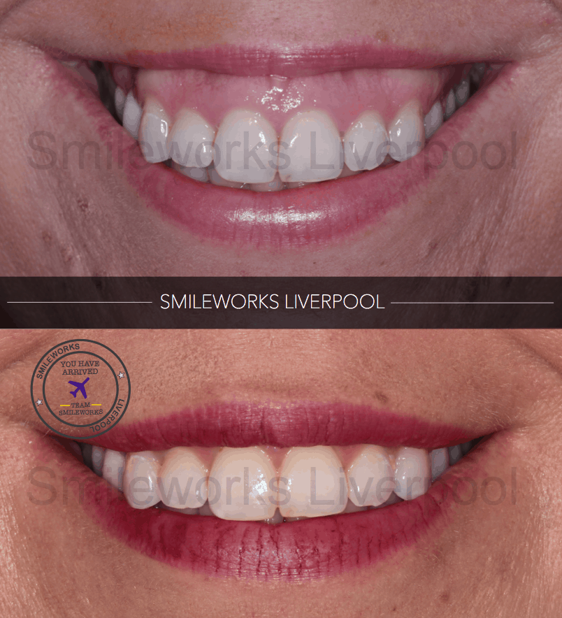 Gummy Smile Treatment Botox, Gum Contouring & Crown lengthening