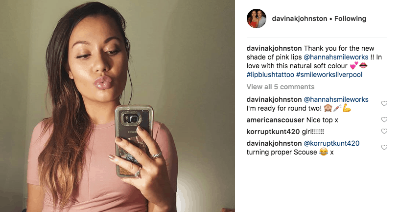 Lip filler instagram selfie