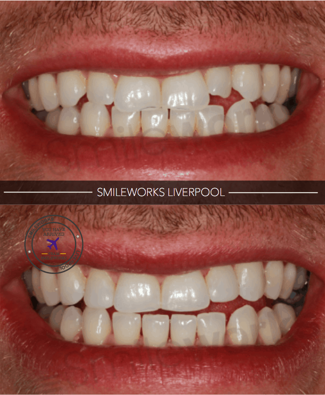 Composite 1b&a 2018